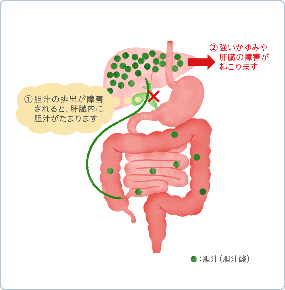 ①胆汁の排出が障害されると、肝臓内に胆汁がたまります ②強いかゆみや肝臓の障害が起こります